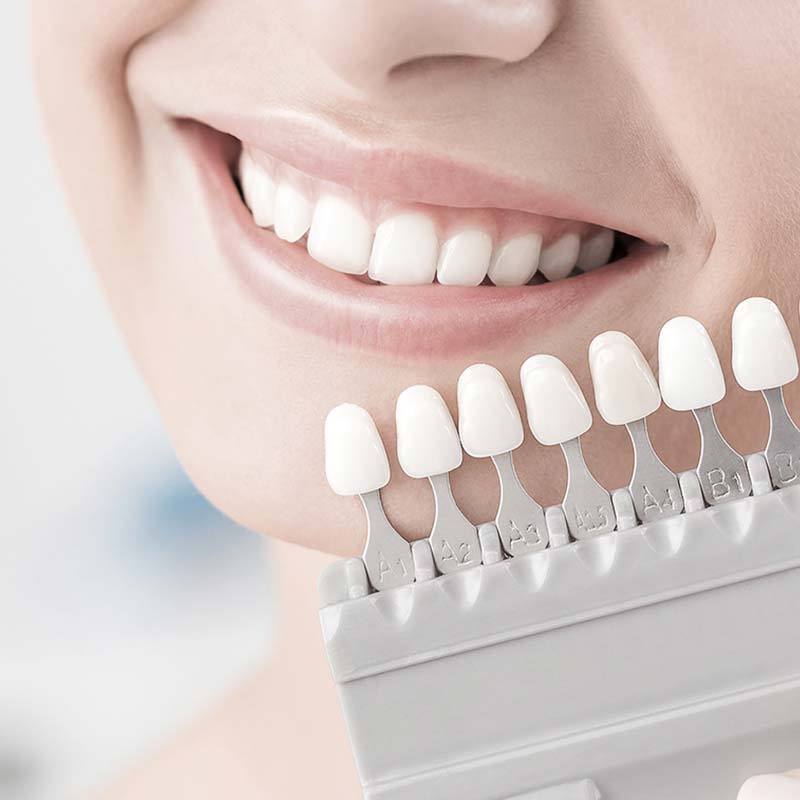 全瓷美學假牙