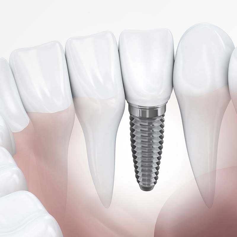 人工植牙 (微創植牙)